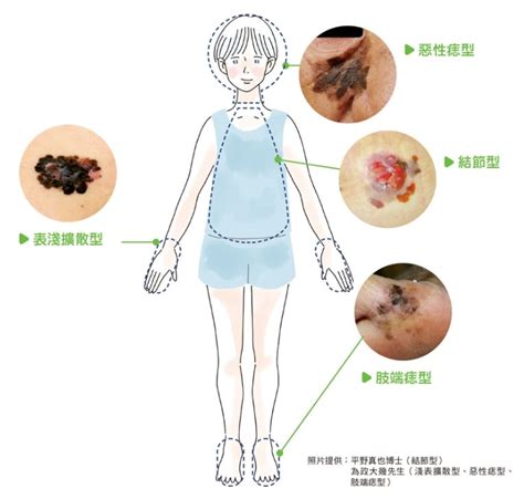 臉上突然長痣怎麼辦|是痣還是瘤？黑色素瘤的類型、症狀與治療